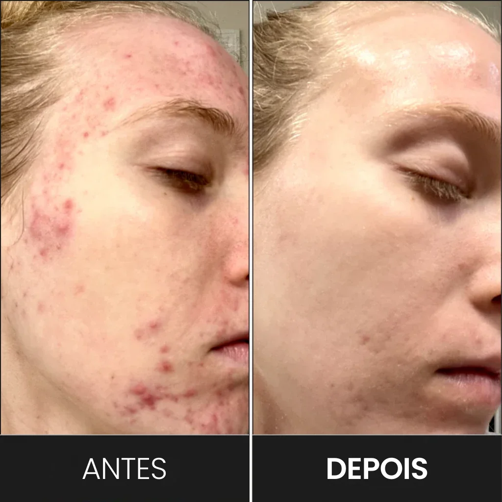 Antes e depois no tratamento de acne com a máscara de LED