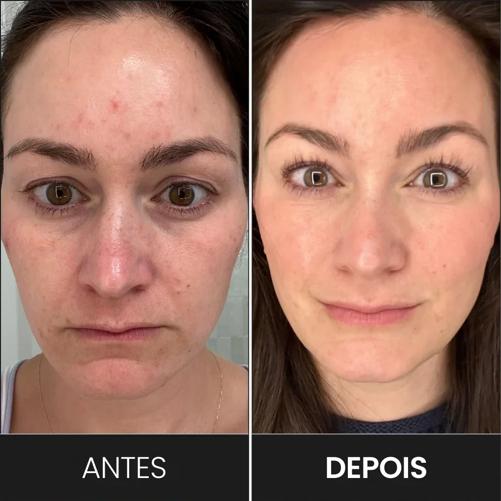 Antes e depois do tratamento com a máscara de LED